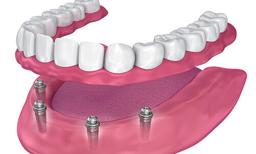 Illustration of an all-on-four procedure done by the Costa Rica Dental Center in San Jose, Costa Rica.  The picture shows an all-on-four being placed in the lower jaw.