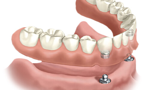 Illustration of a All-on-Two dental procedure done by the Costa Rica Dental Center in San Jose, Costa Rica.  The picture shows an All-on-Two placed in the lower jaw.