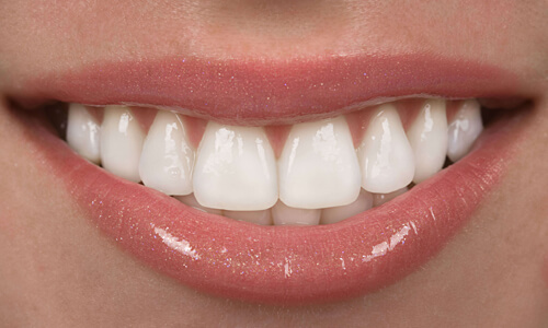 Picture of a woman with perfect teeth after having a Hollywood caps procedure done at the Costa Rica Dental Center in San Jose, Costa Rica.  The picture is a close-up of a perfect smile.