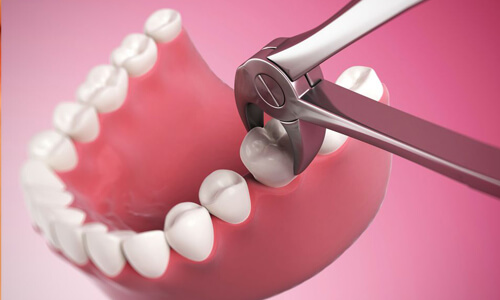 Illustration of a dental extractions procedure done by the Costa Rica Dental Center in San Jose, Costa Rica.  The picture shows a tooth being extracted with dental tools.