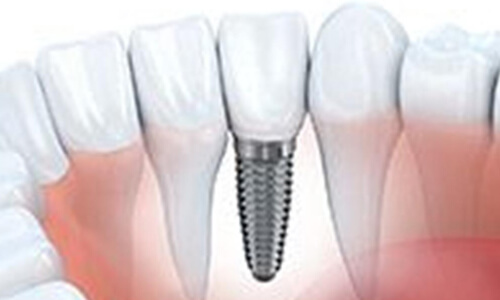 Illustration of a dental implant procedure done by the Costa Rica Dental Center in San Jose, Costa Rica.  The picture shows a dental implant placed in the lower jaw.
