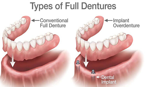 Illustration of an implant-supported denture procedure done by the Costa Rica Dental Center in San Jose, Costa Rica.  The picture shows an implant-supported denture being placed in the lower jaw.